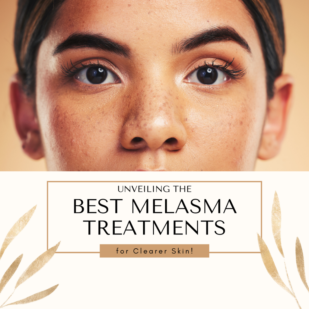 Unveiling the Best Melasma Treatments for Clearer Skin!